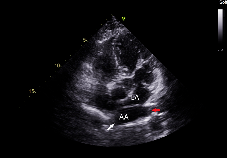 口,短箭头所示隔膜la : 真房, lv :左室,aa :副房图 1 心尖五腔心切面