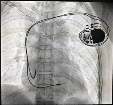 不到2克!全球体积最小的心脏起搏器了解一下