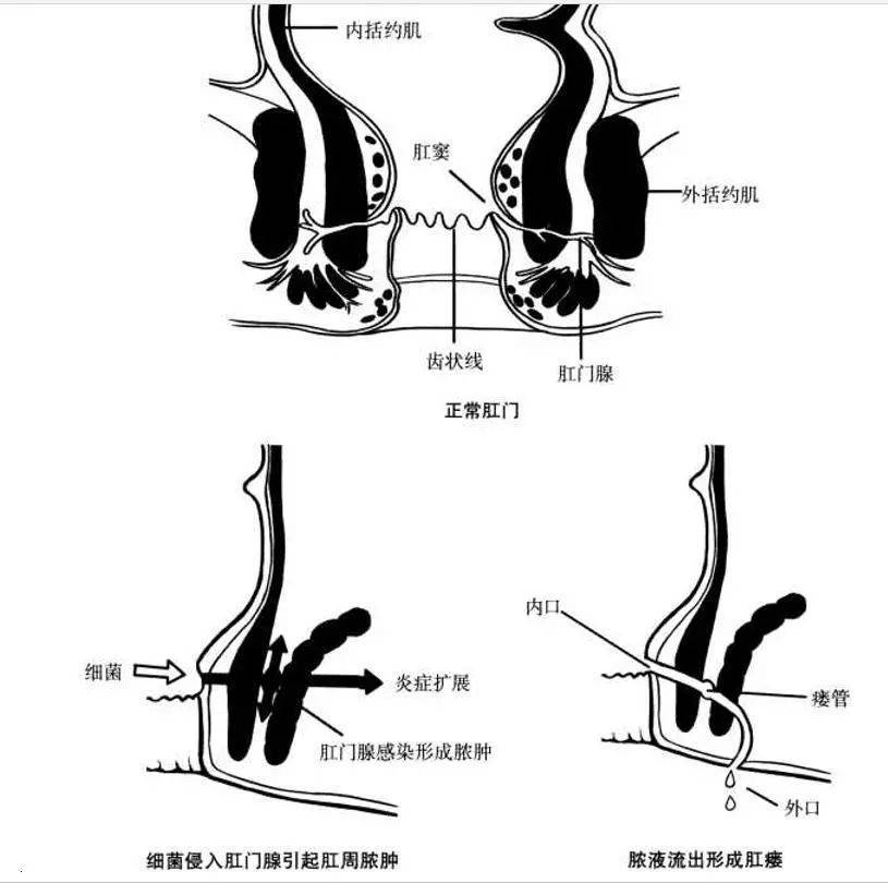 高位肛瘘手术图解图片