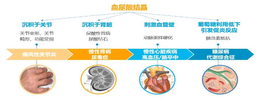 【名医话健康】无声无息的“第四高”——高尿酸血症_控制_运动_建议