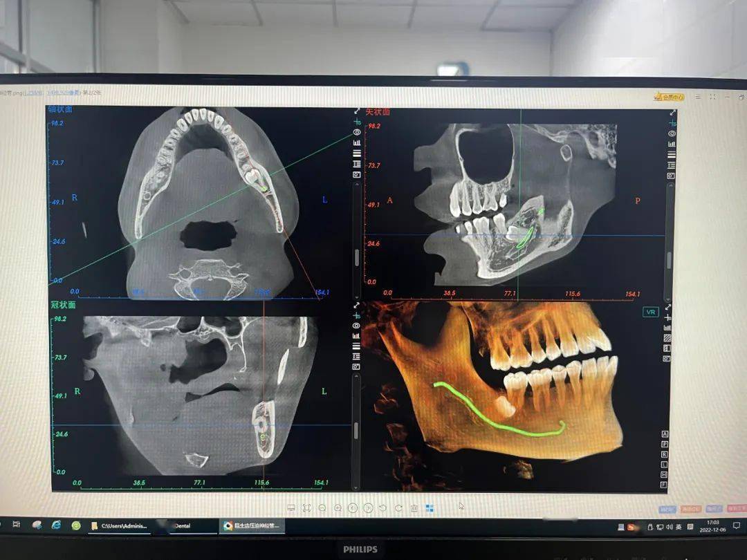 全景片(曲面斷層片):適用於觀察全口牙的健康狀況,上下頜骨腫瘤,外傷