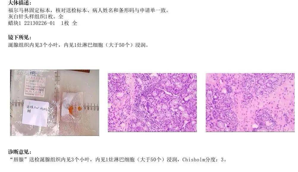 民族医学风湿免疫科成功开展首例小切口唇腺活检_患者_诊断_专科