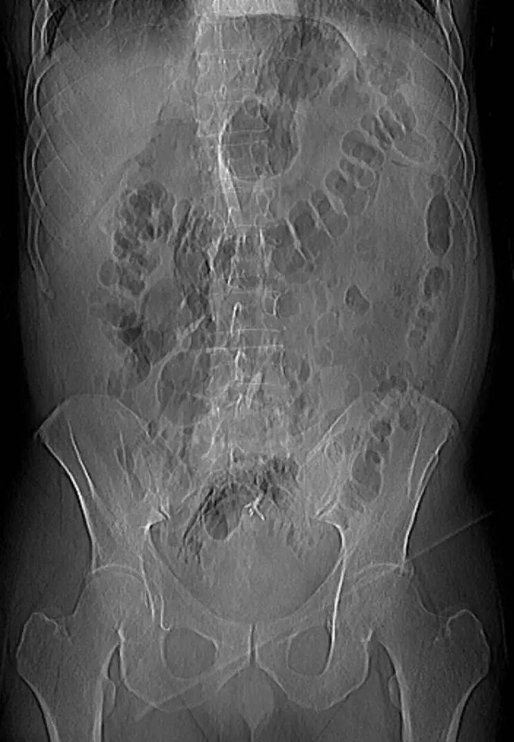 平片示,腹部呈椭圆形,可见轮廓分明的镰状韧带——足球征及镰状韧带征