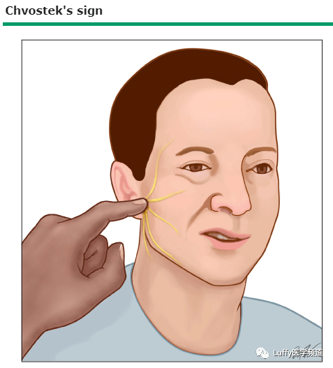 面神经征 — 面神经征是通过叩击恰好在耳前的面神经引出同侧面部肌肉