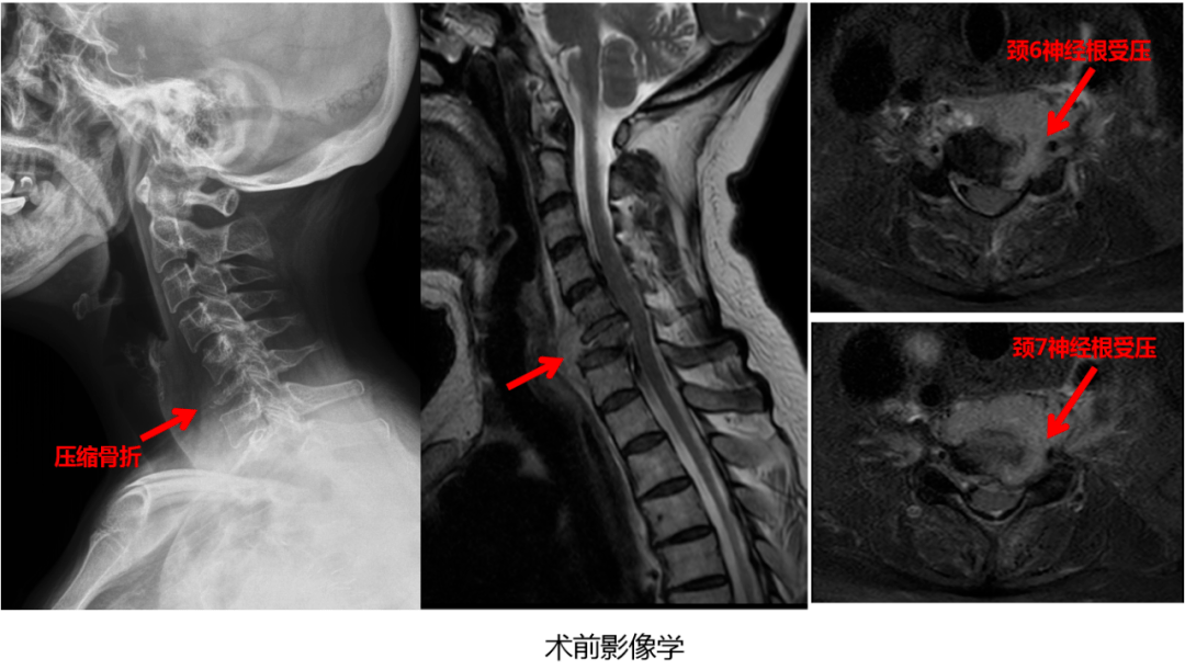 肺癌颈椎转移图片图片