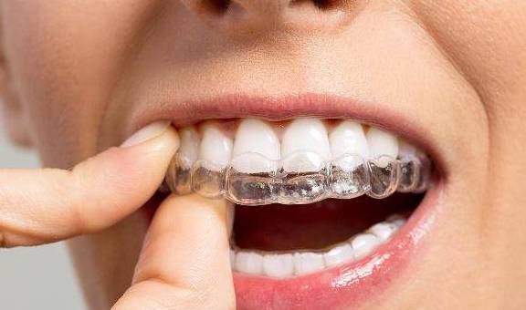 牙齿矫正之后,牙套保持器要佩戴多长时间?_矫治_问题_生活习惯
