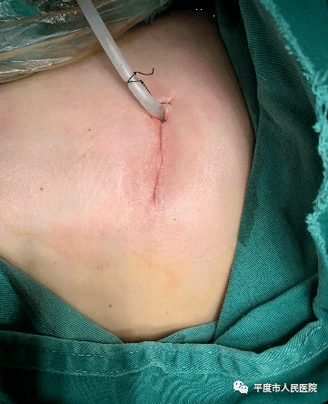 微创肛瘘手术刀口图片图片