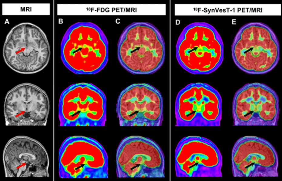 湘雅医院一体化pet/mr"点亮"真凶_诊断_病灶_小张