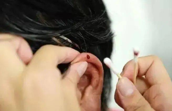 ①穴位放血疗法常用穴位:大椎,少商,曲池,双耳尖,十宣等,通过刺入皮肤
