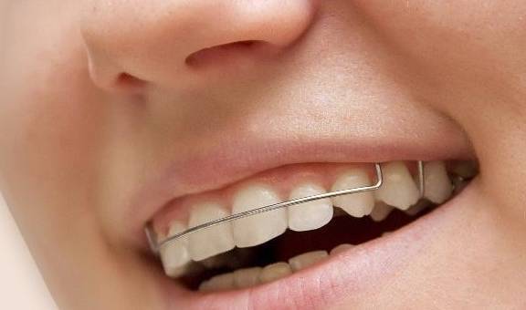 有"哨牙"很自卑,能不能矫正?_牙齿_矫治_功用