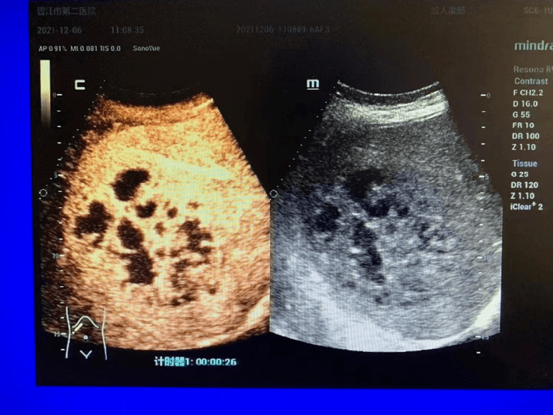 竟是肝脓肿作祟!安海医院开展超声引导下穿刺介入手术_患者_治疗_效果