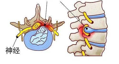 腰椎間盤突出可壓迫馬尾神經,出現馬尾綜合徵,即大小便障礙,鞍區感覺