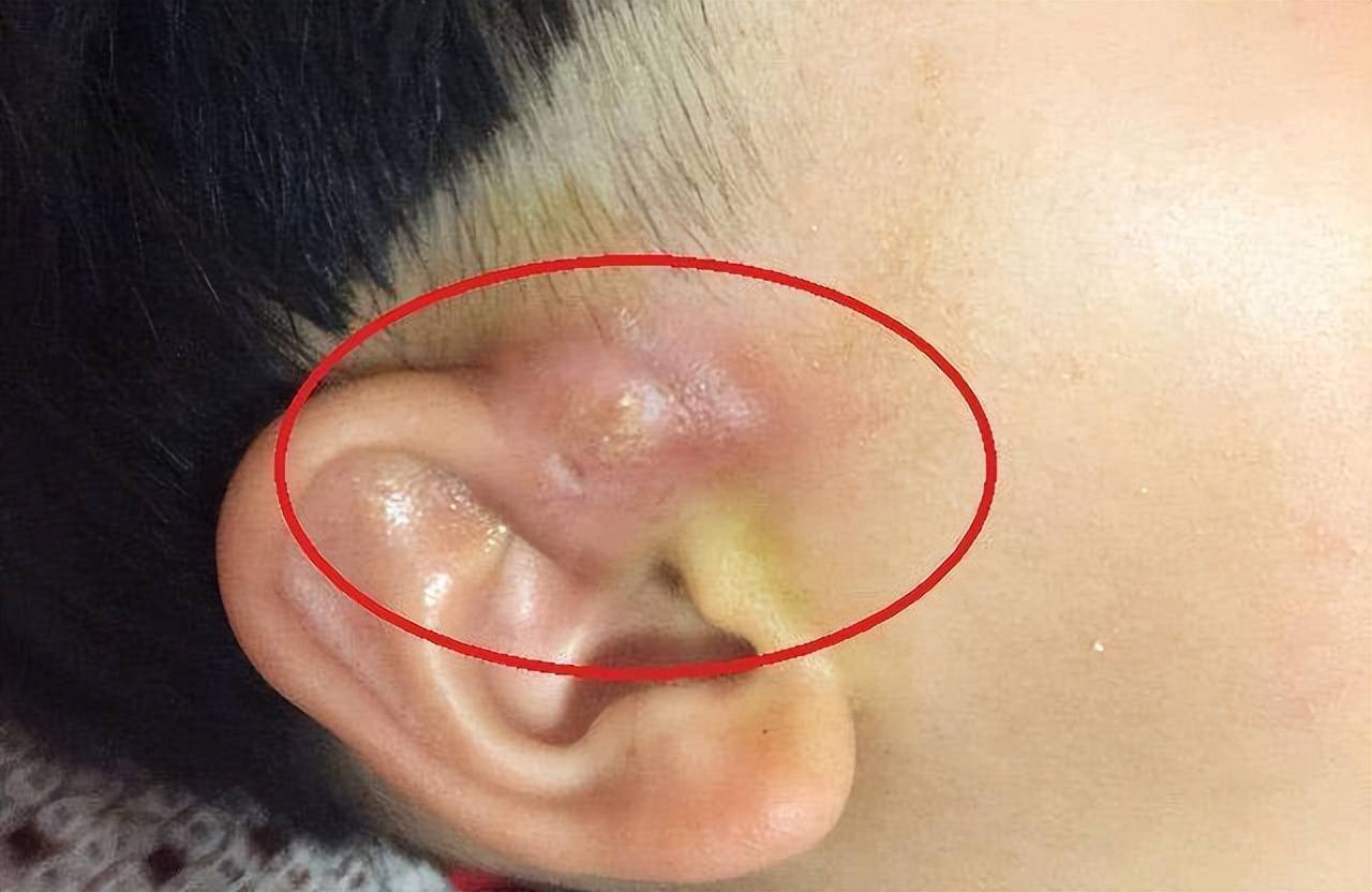娃耳朵上有"小孔"是福气的象征?医生不说,家长也得知其危害性