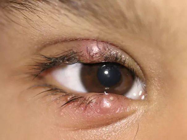眼红,流泪,分泌物增多等症状,那就可能是结膜炎发作了