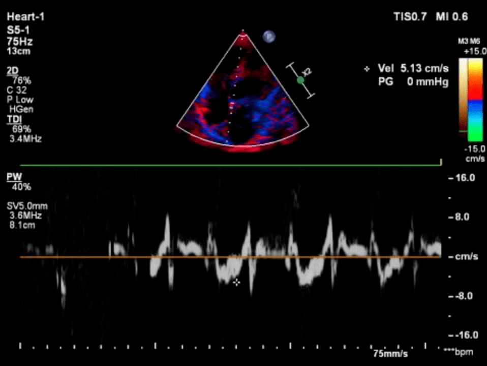 心脏移植术后的超声心动图评估