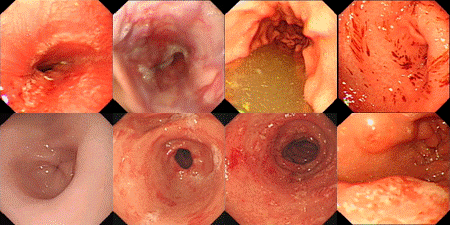 胆汁反流胃镜图片图片