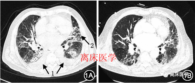 如何處理?_玻璃_肺部_積液