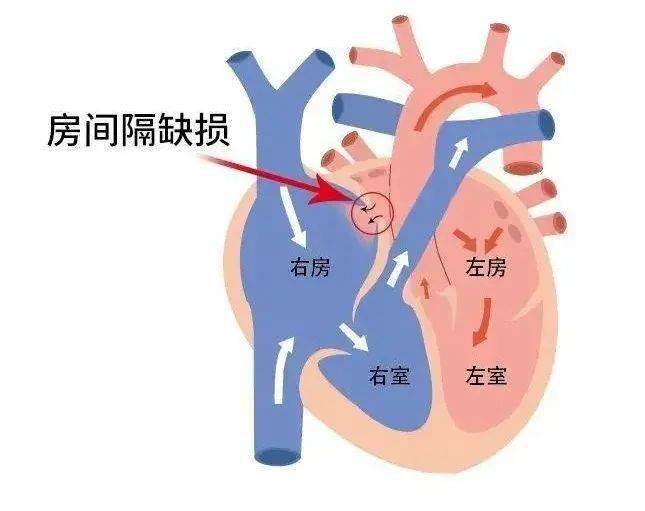 经过检查发现,老人家患有先天性房间隔缺损(继发孔型) 三尖瓣反流 肺