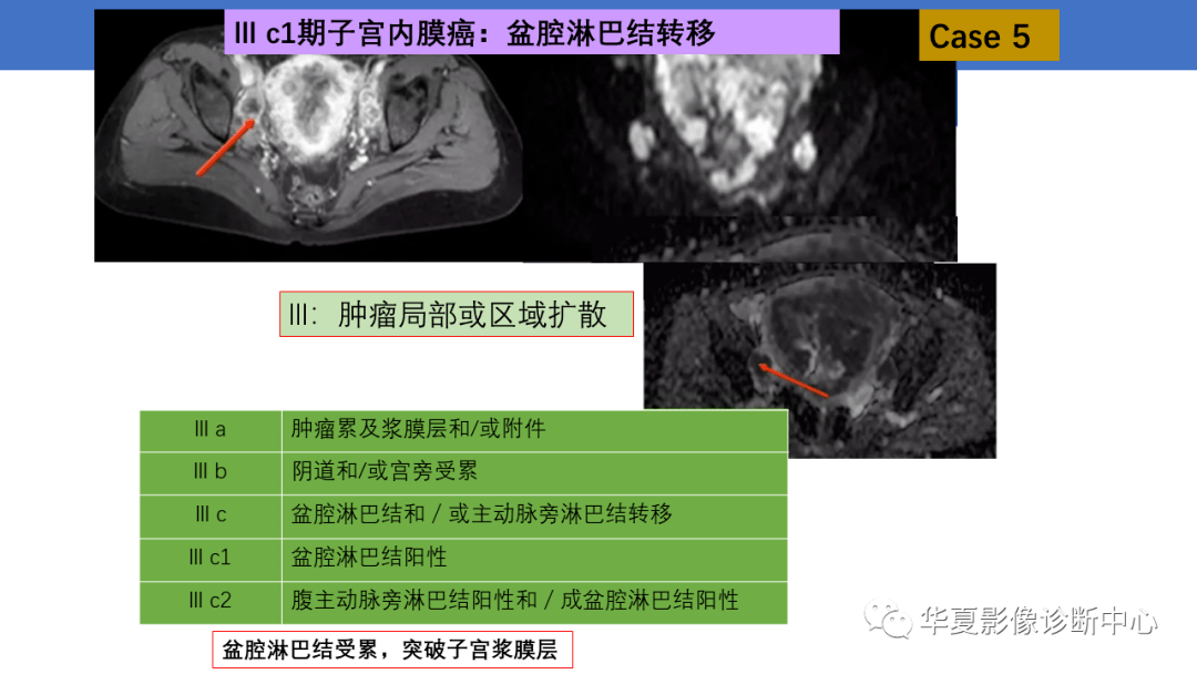 子宫内膜疾病的MRI诊断及鉴别_影像_平台_微信