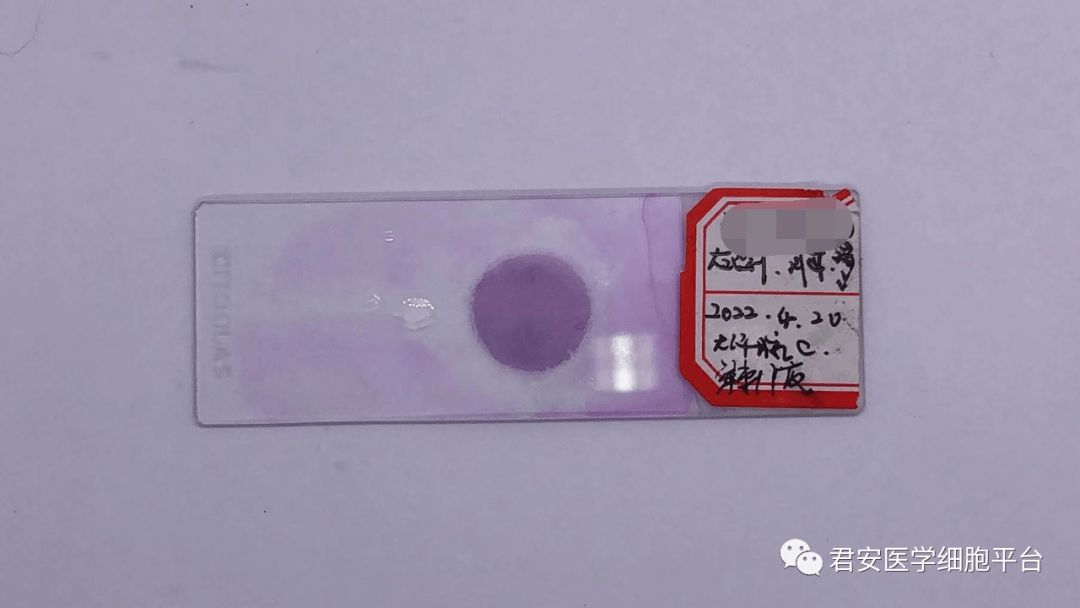 湿片可见脂肪颗粒细胞,脂肪滴,苏丹Ⅲ阳性,大汗腺细胞糖原染色强阳性