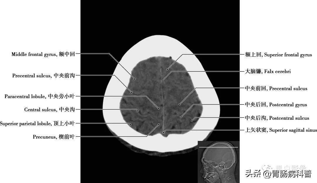 上矢状窦 为单一的硬脑膜静脉窦,位于大脑镰上缘,前起于盲孔,后连于