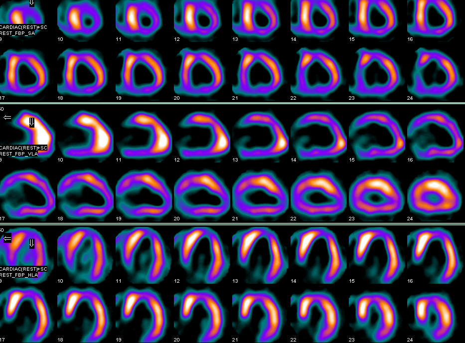 大学总医院核医学科的99mtc-mibi心肌灌注显像(mpi)无创性检测方法,对