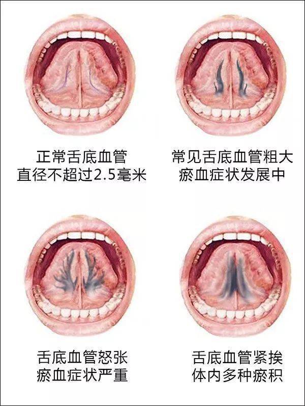 舌下出血点图片图片