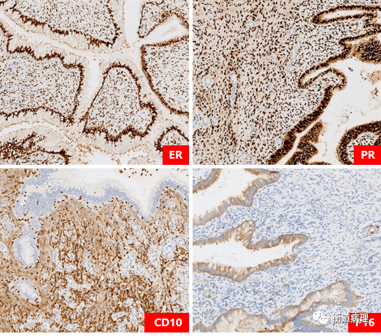 1免疫组化* 腺肉瘤伴肉瘤样过度生长(adenosarcoma with sarcomatous