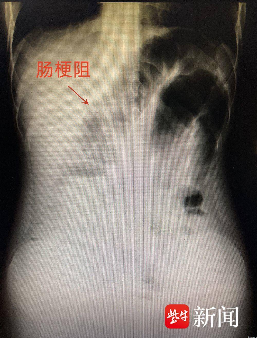 肠梗阻腹平片影像图图片