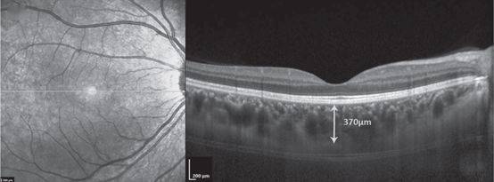 中心凹下脉络膜厚度测量具体测量及正常值可以参照下图.