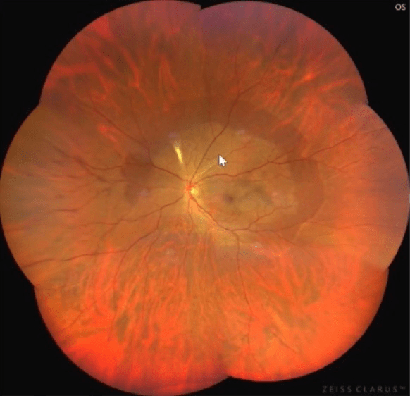 超广角眼底照相机 | 拍摄技巧(超实用)_患者_镜头_方法