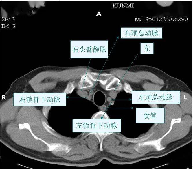 肺部ct解剖图 断层图片