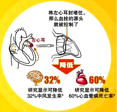 潍坊市人民病院心内一科胜利完成一例复杂左心耳封堵术