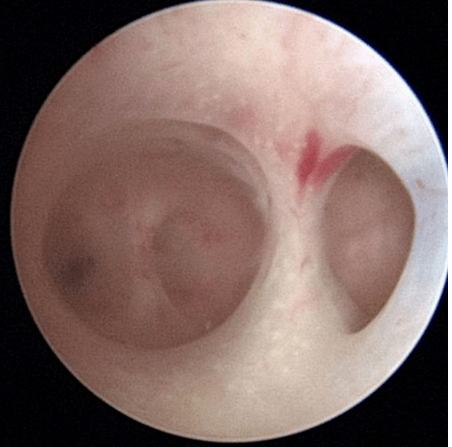 【健康科普|医生说】宫腔镜——女性健康的"明镜"_检查_子宫_治疗