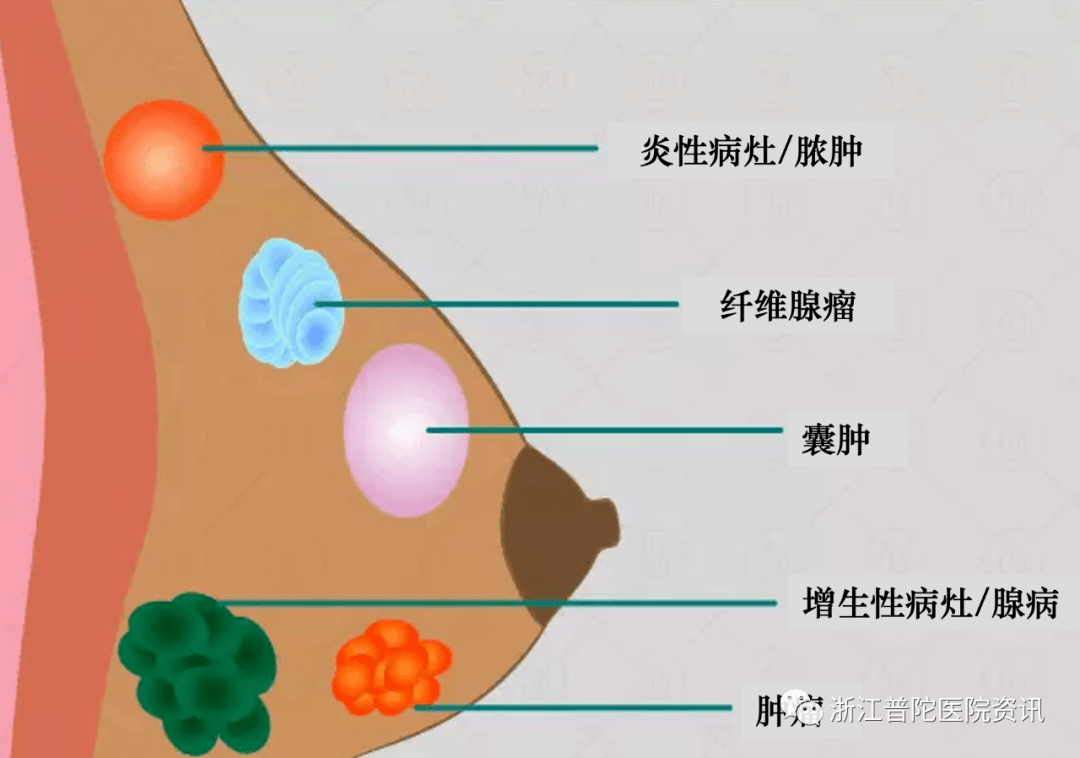 乳晕结节图片图片