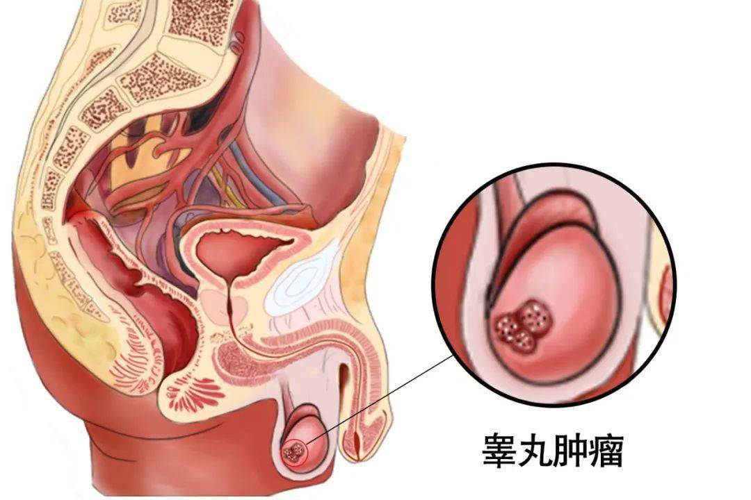 睾丸癌男士图片