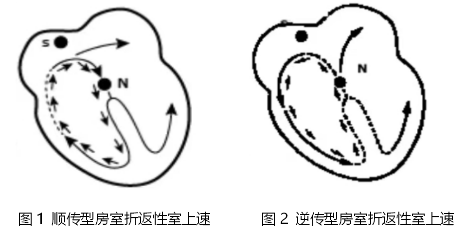 主要由折返機制引起,少數因自律性增高所致.