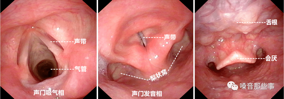 喉镜会厌图片图片