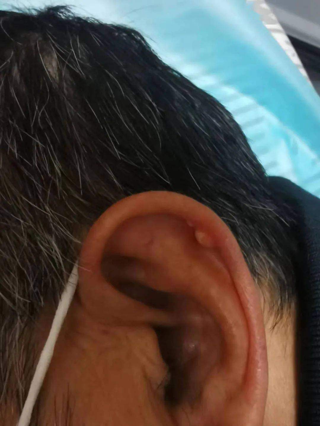 典型图片61耳廓(耳轮)痛风晶体集聚(痛风石)