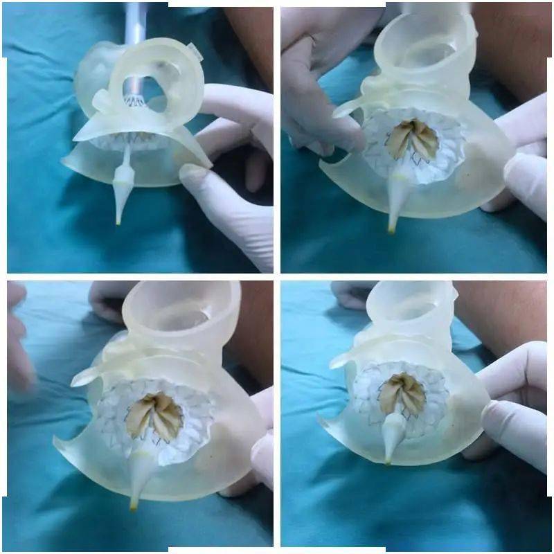 关闭不全,肺动脉关闭不全,高血压3级(高危),冠状动脉粥样硬化性心脏病