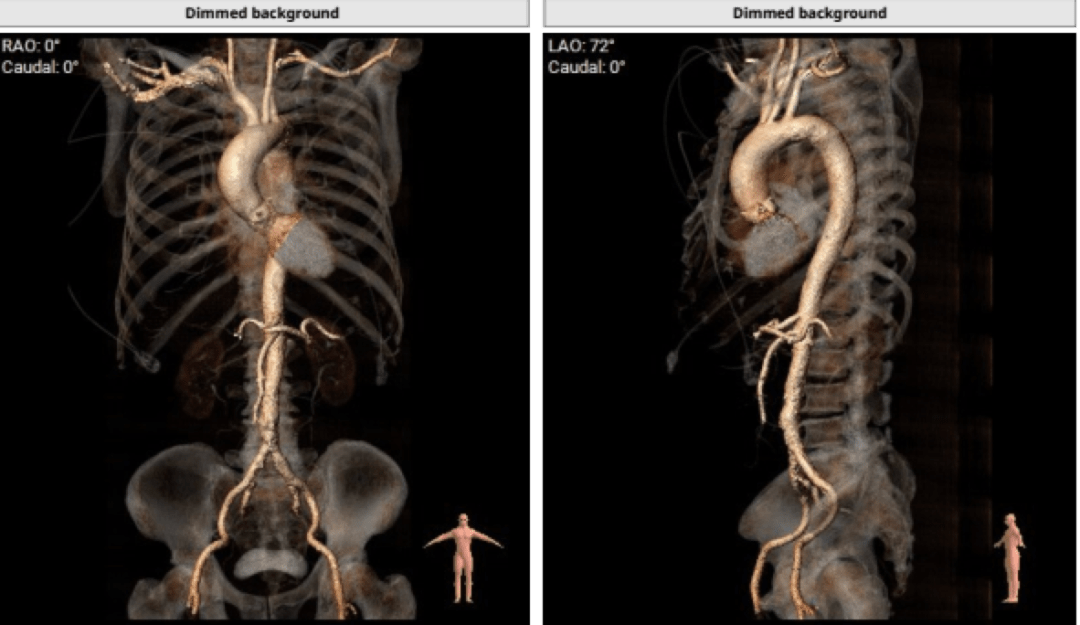 入路情况:主动脉弓部走行较平缓,主动脉弓部三根毛开口未见明显狭窄