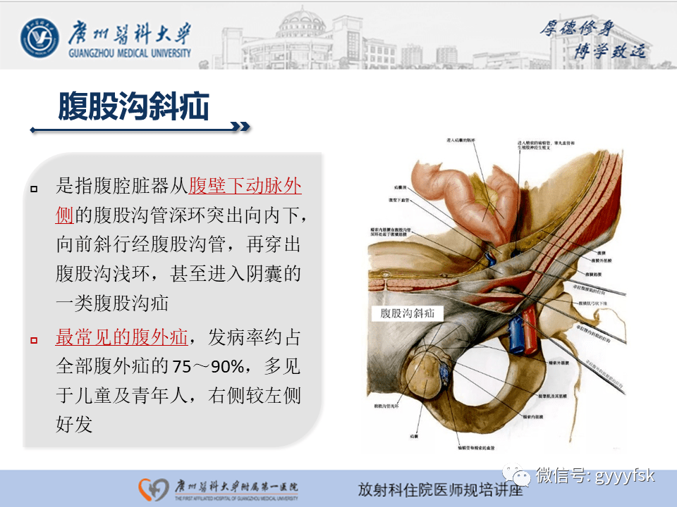 腹外疝的影像诊断