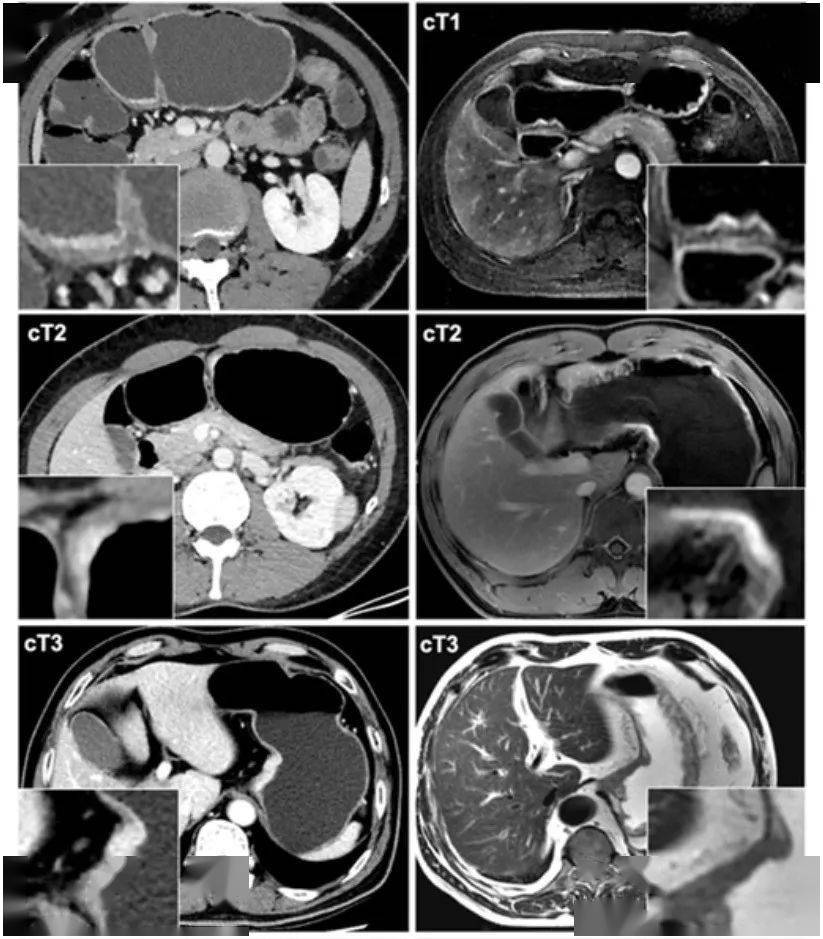 胃癌ct分期的模式图和影像图附录二:胃癌淋巴结分组no.