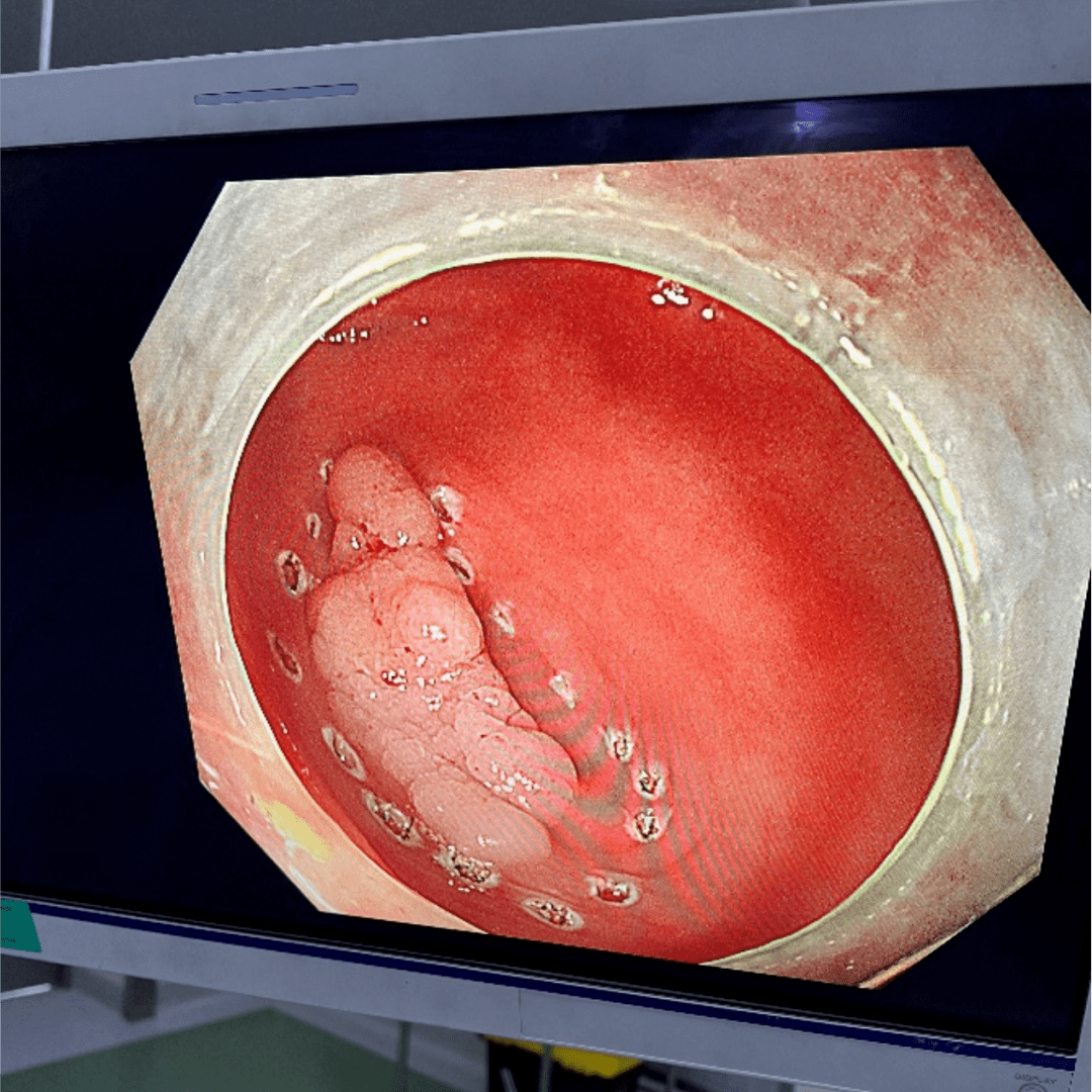 在复杂肿瘤发生癌变前,用这项技术成功切除了!_阑尾_手术_阿姨