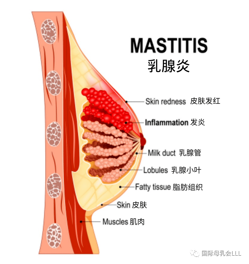 乳腺炎乳房图片症状图片