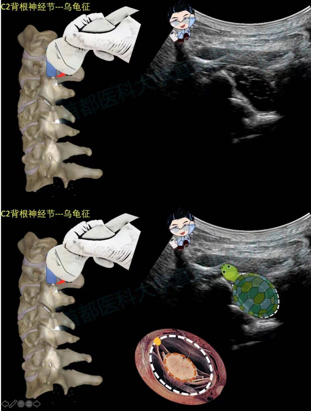 "之后通过超声技术定位颈2背根神经节及周围解剖结构的一个完整性区域