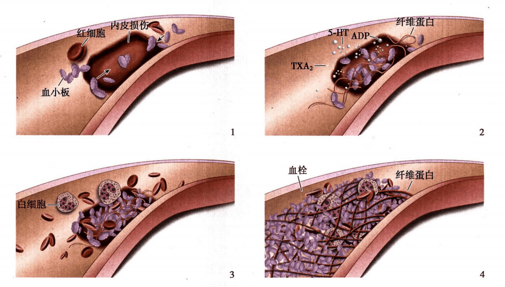 血栓形成过程及血栓的类型与形态,一文读懂!