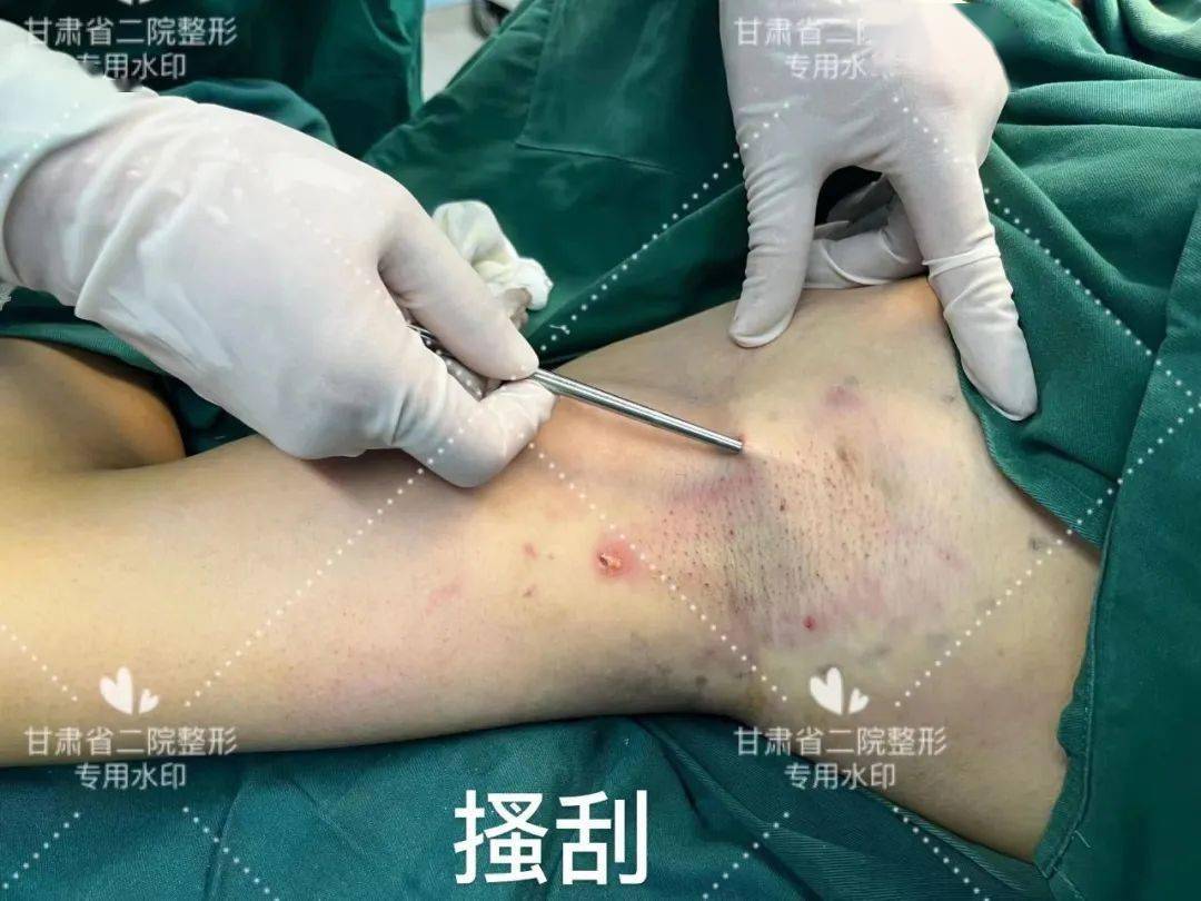 腋臭挂号中心(腋臭医院挂哪个科室)