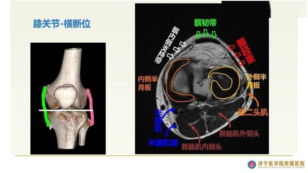 膝关节mri解剖及常见病诊断