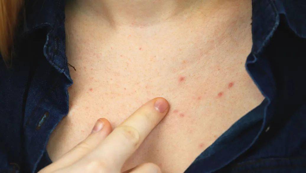 别把毛囊炎当成青春痘,主要症状是这4个!_患者_治疗_痘痘